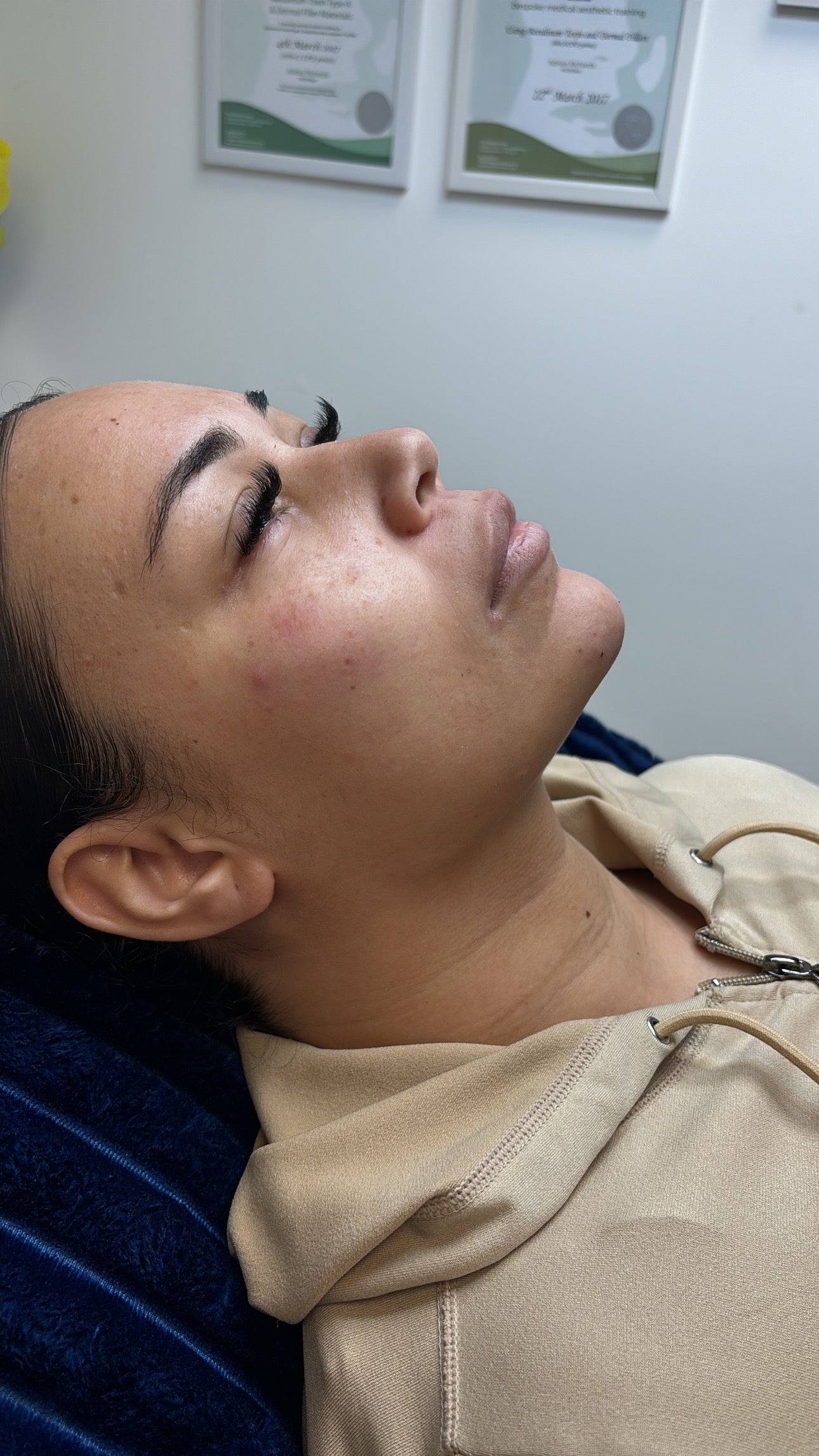 Facial sculpting using filler 4.4ml