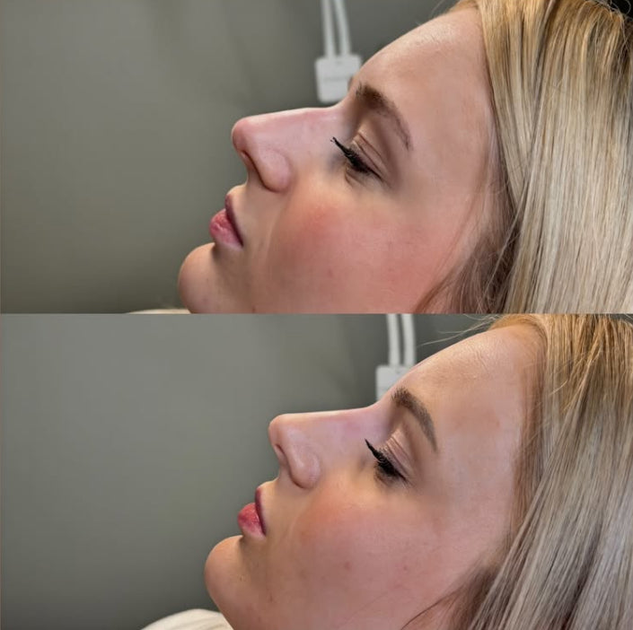 Liquid rhinoplasty 1.1ml