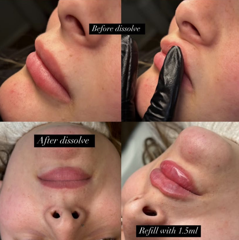 Dissolve and refill package filler