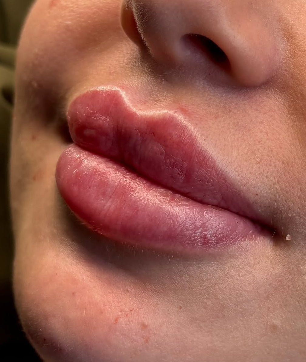 Lip filler 1.1ml
