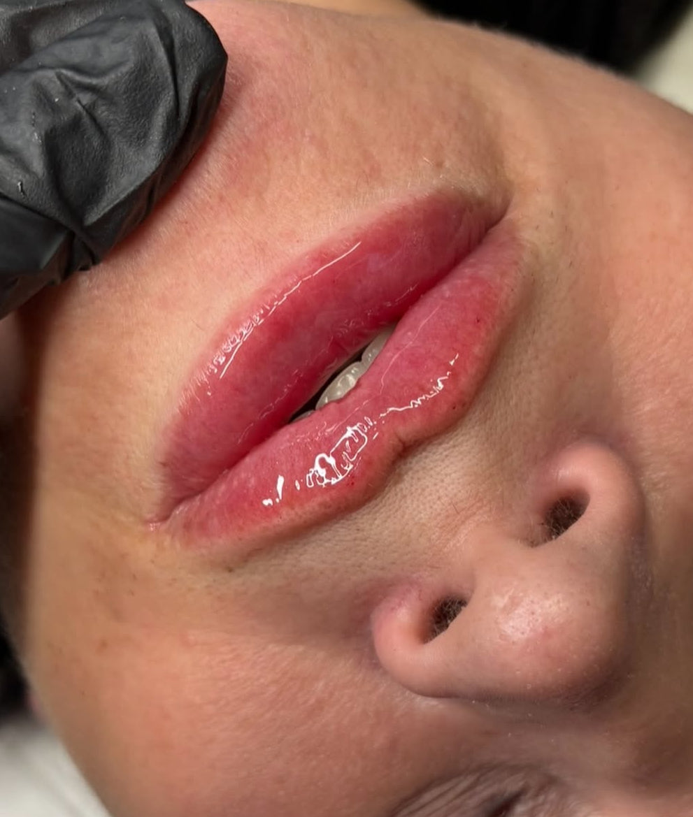 Lip filler 1.1ml