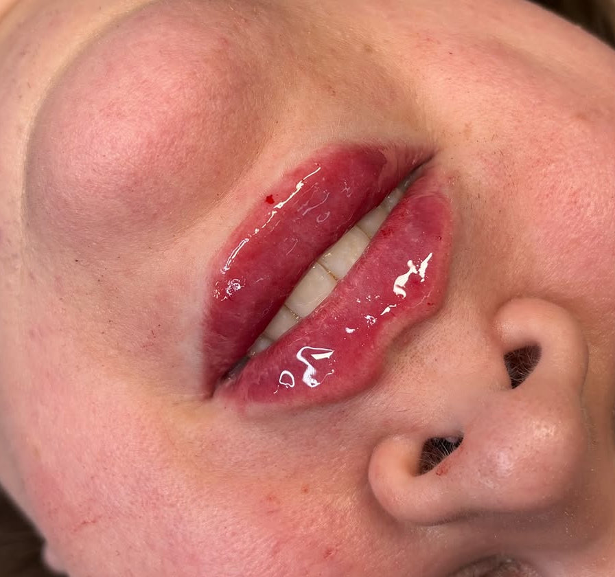 Lip filler 1.1ml
