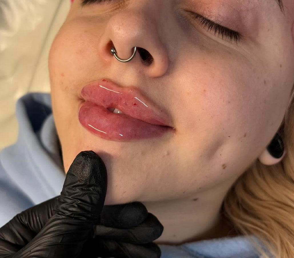Lip filler 1.1ml