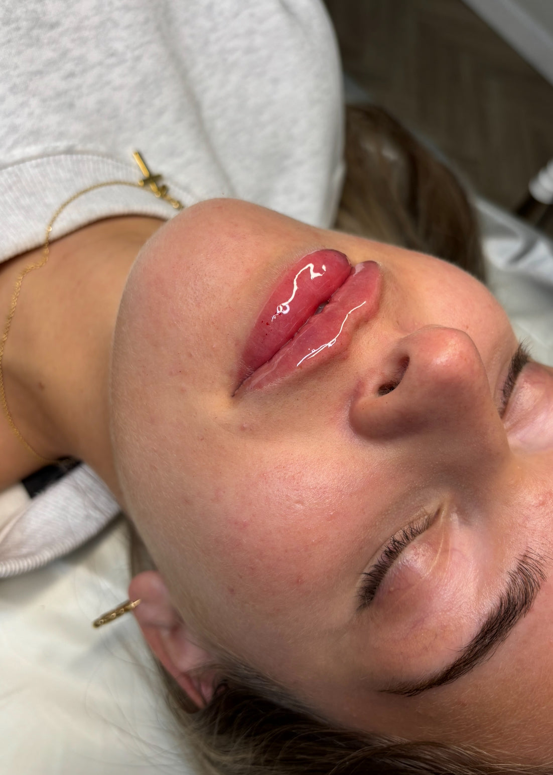 Lip filler 1.1ml