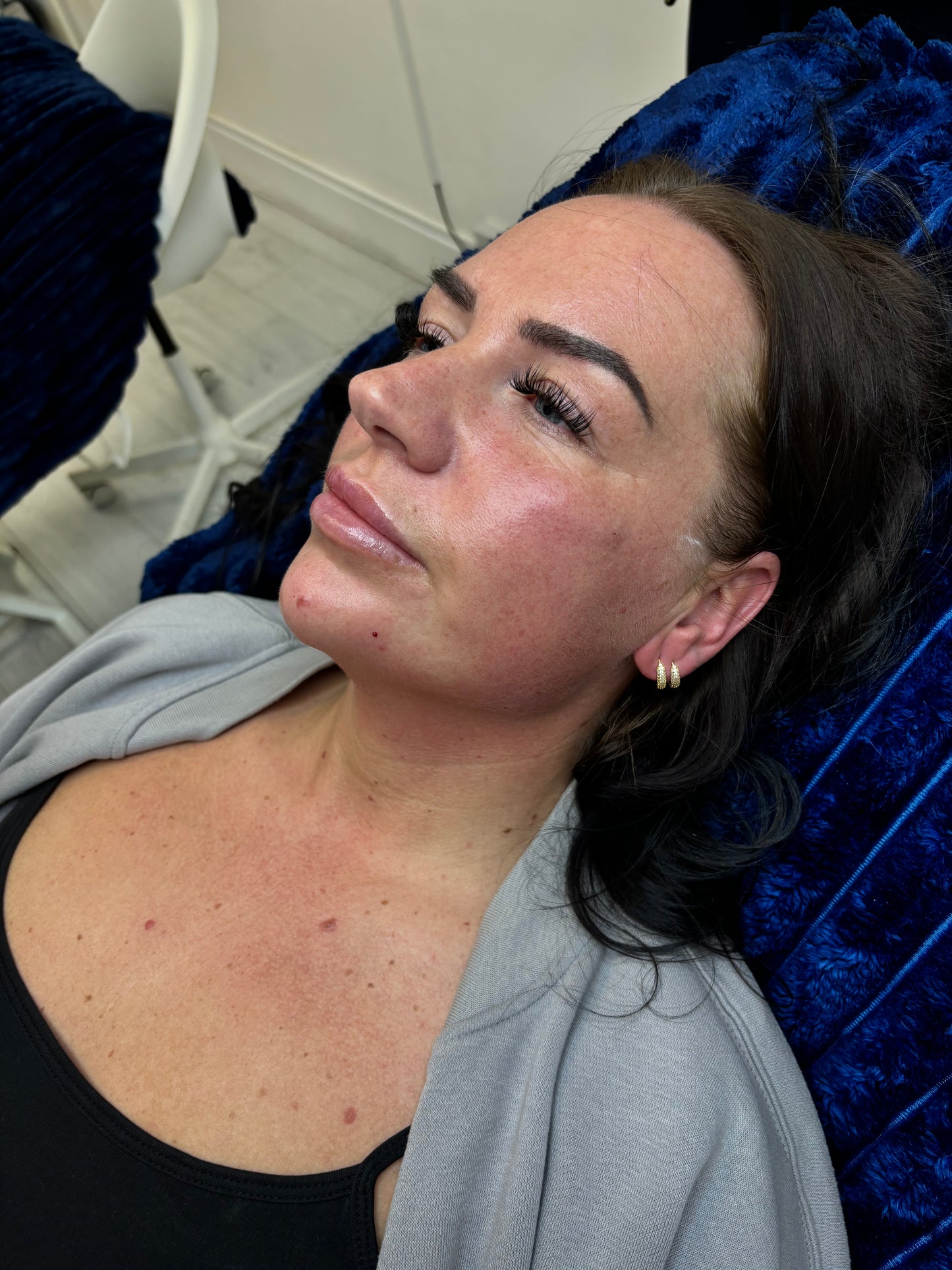 Facial sculpting using filler 4.4ml