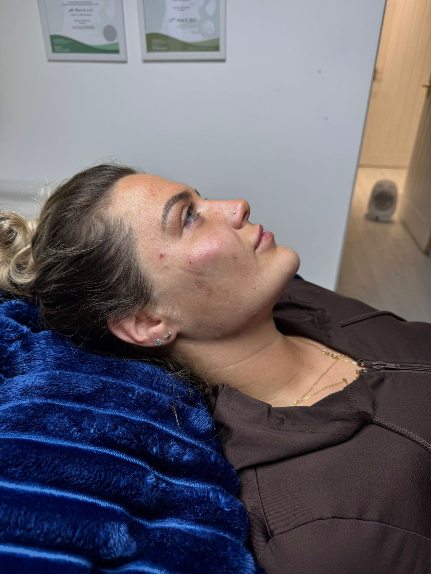 Facial sculpting using filler 4.4ml