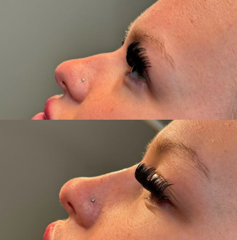 Liquid rhinoplasty 1.1ml