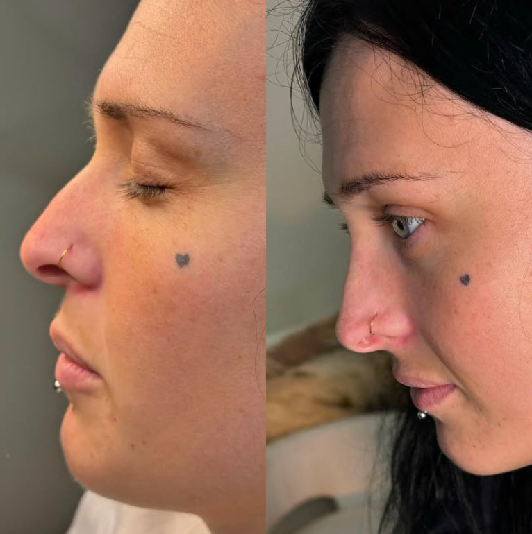 Liquid rhinoplasty 1.1ml