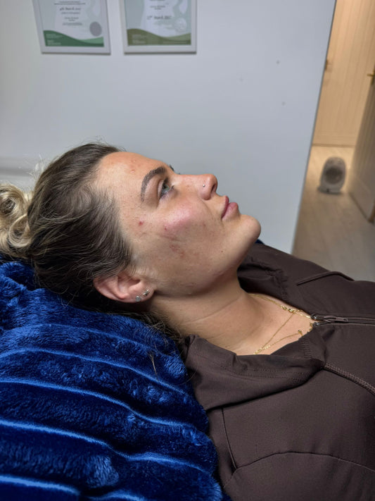 Facial sculpting using filler 4.4ml